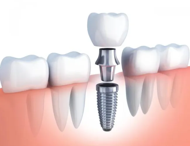 Wann Implantate gesetzt werden: Indikationen und Kontraindikationen